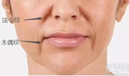 如何去除木偶紋?去木偶紋的護膚技巧,使你長相暴漲