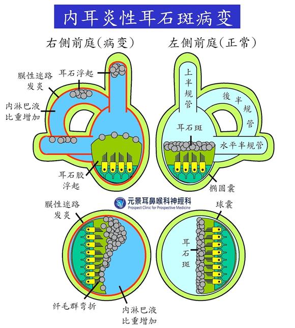 50歲男子頻繁暈眩,耳鳴暈眩權(quán)威診斷發(fā)現(xiàn):內(nèi)耳炎性橢圓囊及球囊病變
